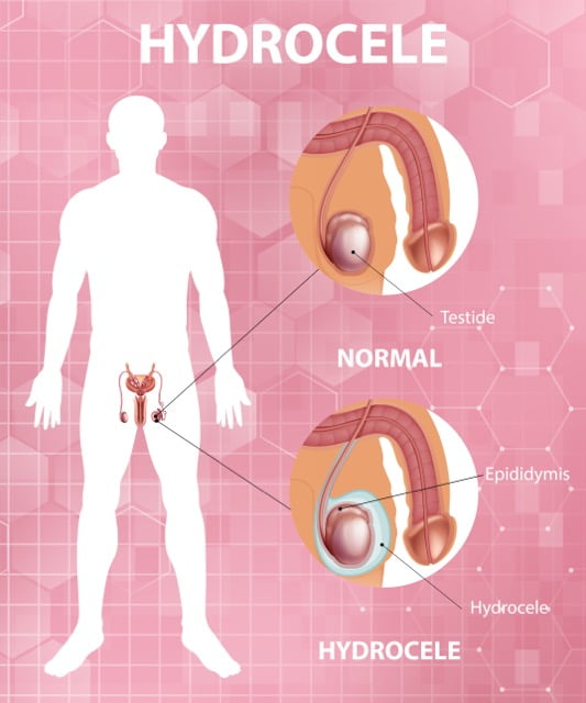 HYDROCELE SURGERY -- DR SHIVRAJ HOSPITAL