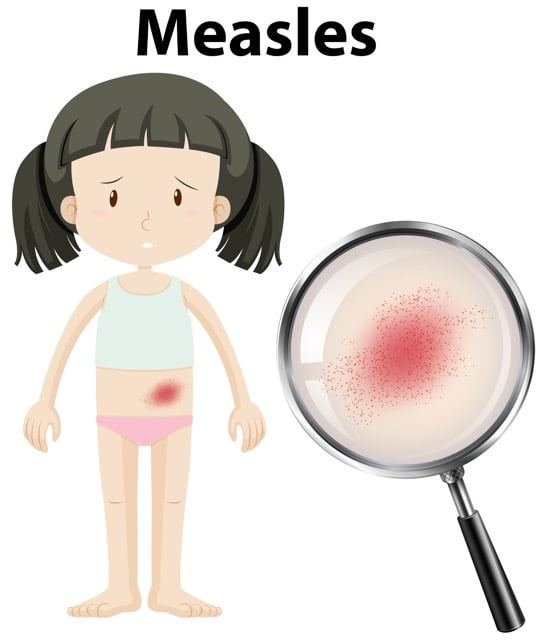 MEASLES खसरा TREATEMENT BY DR SHIVRAJ SINGH