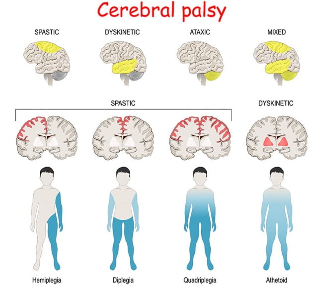 CEREBRAL PALSY