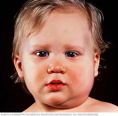 MUMPS DISEASE - DR SHIVRAJ HOSPITAL SIKAR