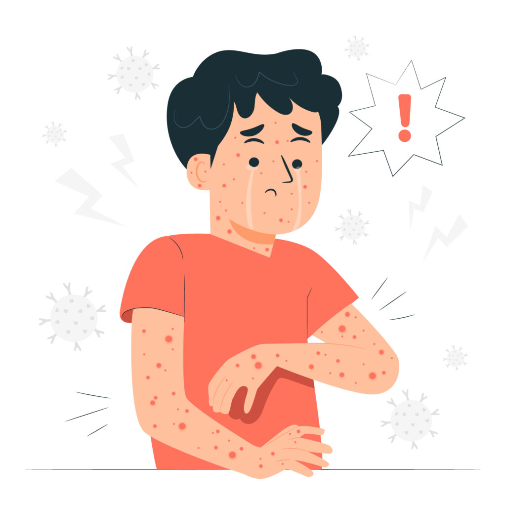 chicken pox