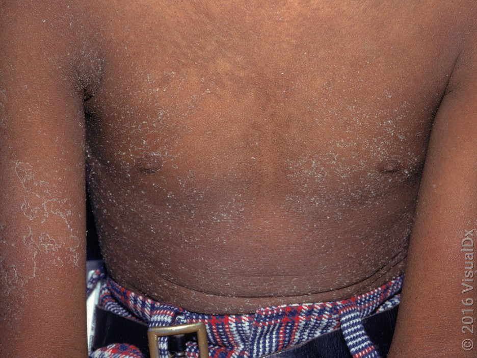 scarlet fever symptoms