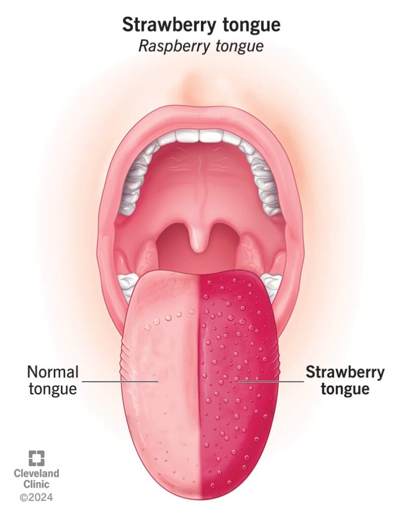 strawberry tongue in scarlet fever